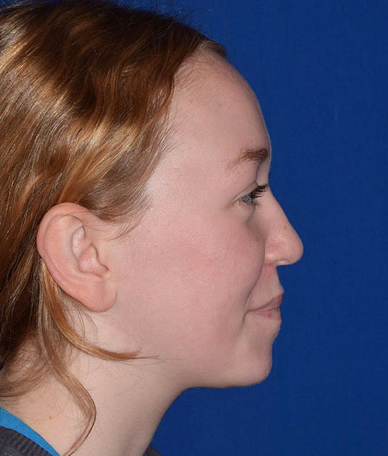 Face Before & After Gallery - Patient 63360417 - Image 6