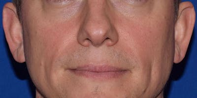 Cosmetic Surgical Before & After Gallery - Patient 63360418 - Image 1