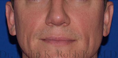 Face Before & After Gallery - Patient 63360418 - Image 2