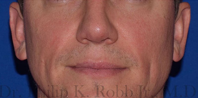 Cosmetic Surgical Before & After Gallery - Patient 63360418 - Image 2