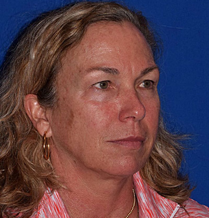 Face Before & After Gallery - Patient 63360424 - Image 3
