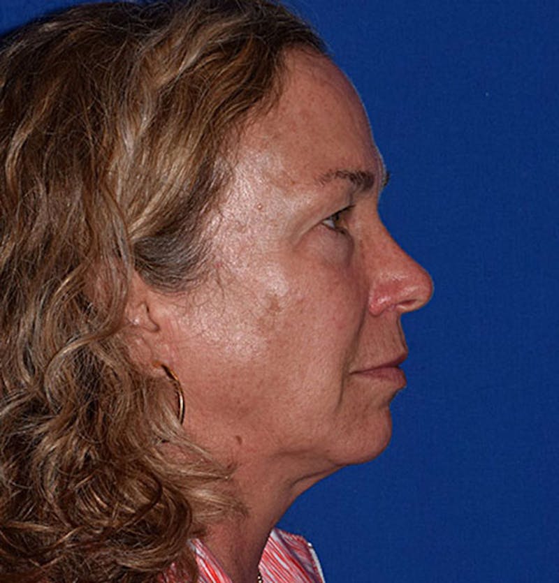 Cosmetic Surgical Before & After Gallery - Patient 63360424 - Image 5