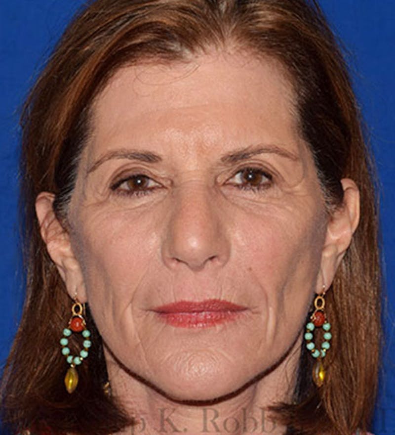 Face Before & After Gallery - Patient 63360429 - Image 2