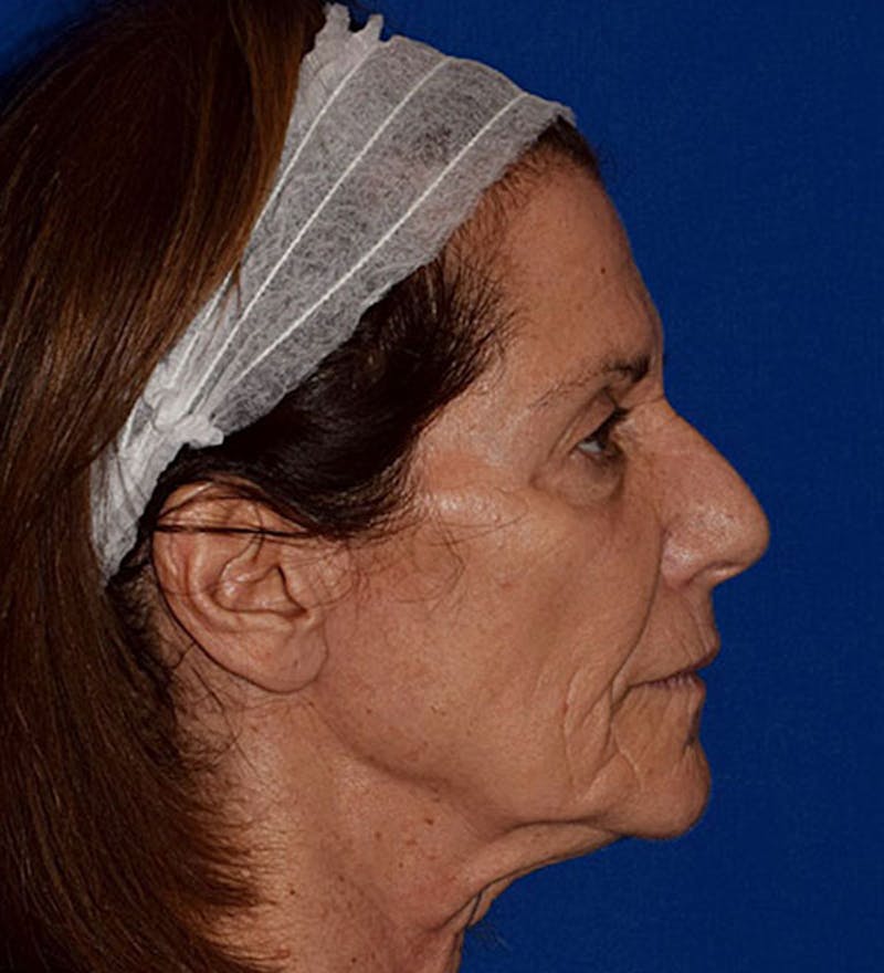 Cosmetic Surgical Before & After Gallery - Patient 63360429 - Image 5