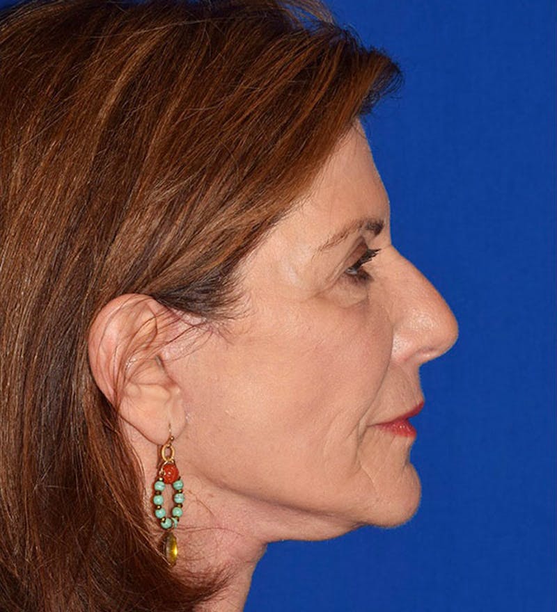 Face Before & After Gallery - Patient 63360429 - Image 6