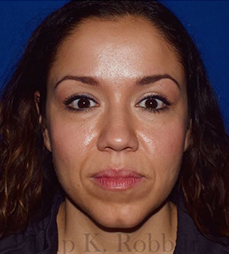 Face Before & After Gallery - Patient 63360435 - Image 2