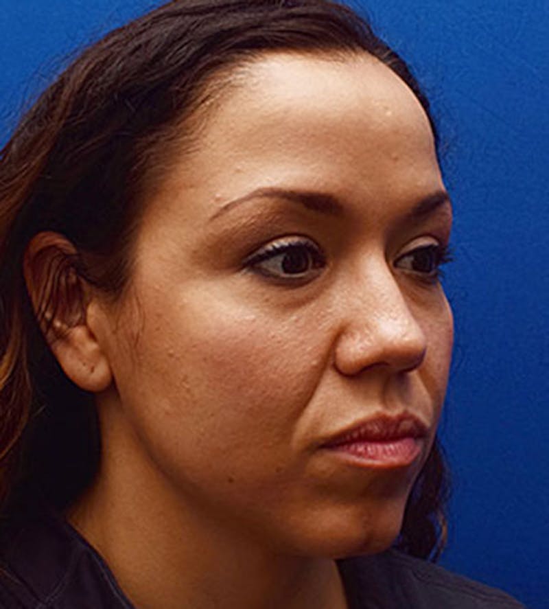 Face Before & After Gallery - Patient 63360435 - Image 3