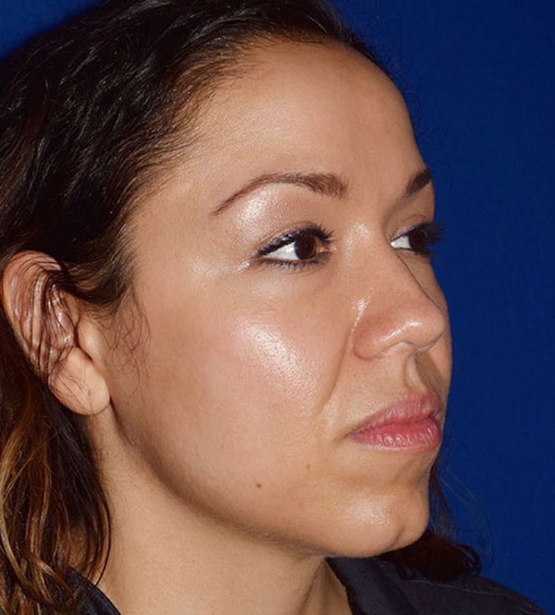 Face Before & After Gallery - Patient 63360435 - Image 4