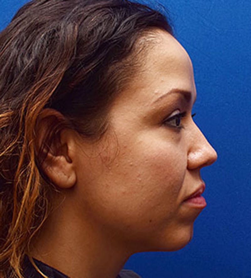 Face Before & After Gallery - Patient 63360435 - Image 5
