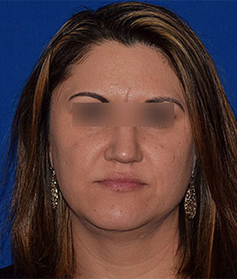 Face Before & After Gallery - Patient 63360436 - Image 1