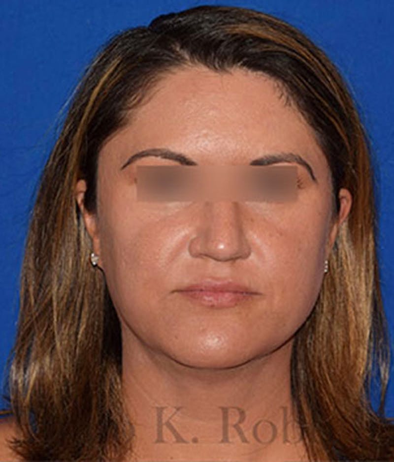 Face Before & After Gallery - Patient 63360436 - Image 2