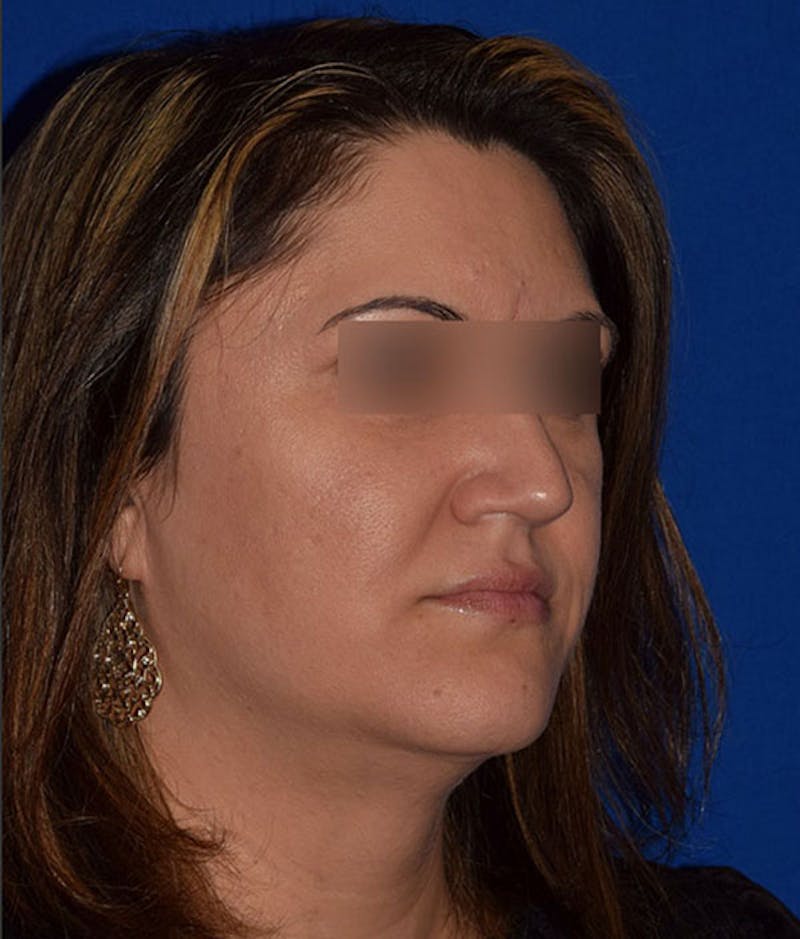 Face Before & After Gallery - Patient 63360436 - Image 3