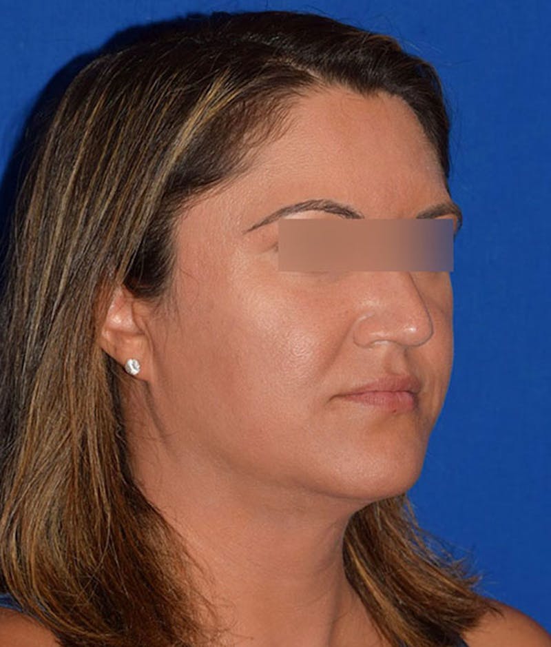 Cosmetic Surgical Before & After Gallery - Patient 63360436 - Image 4