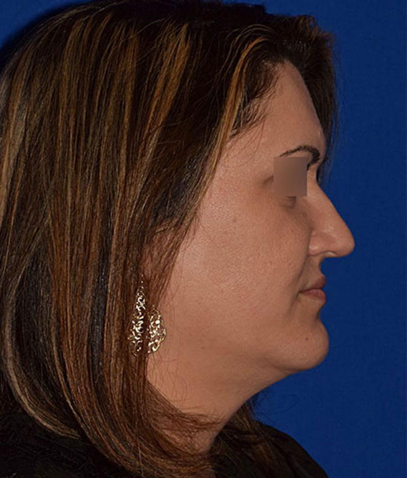 Cosmetic Surgical Before & After Gallery - Patient 63360436 - Image 5