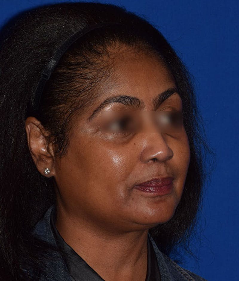 Face Before & After Gallery - Patient 63360440 - Image 3