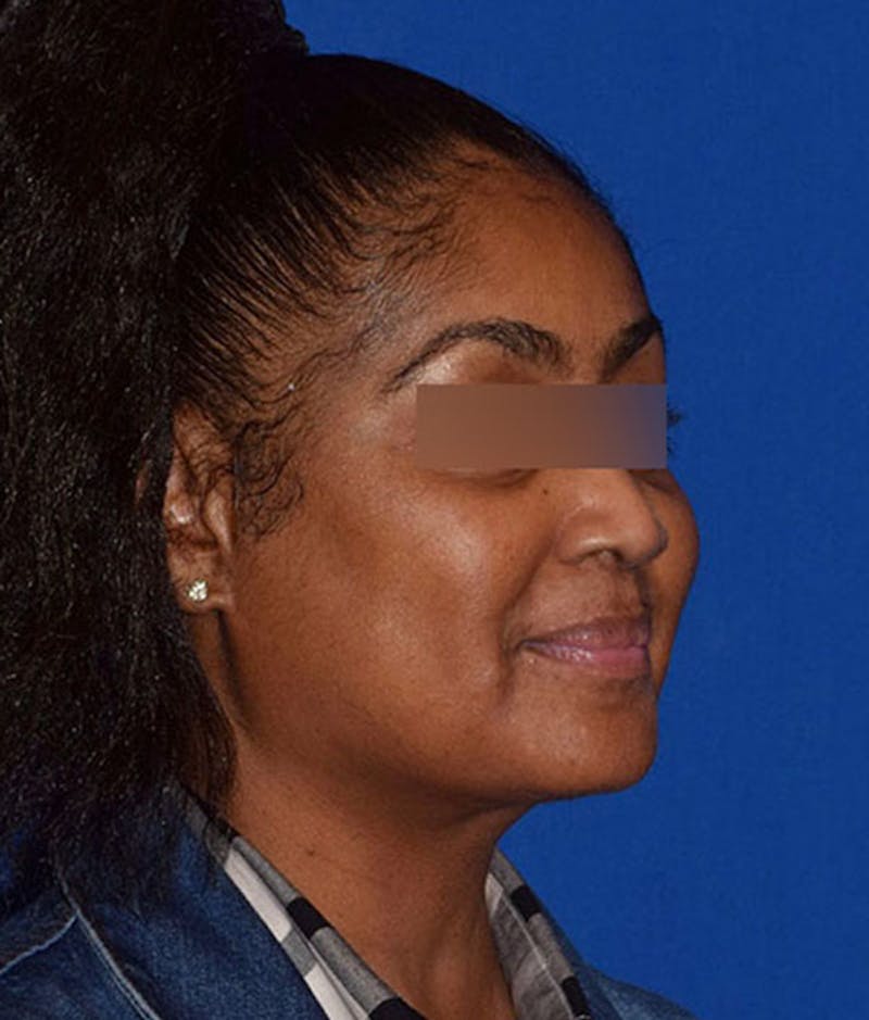 Face Before & After Gallery - Patient 63360440 - Image 4