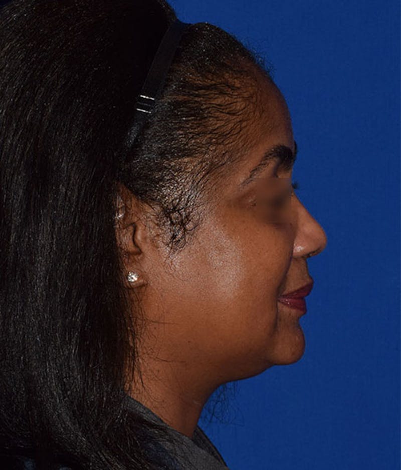 Face Before & After Gallery - Patient 63360440 - Image 5
