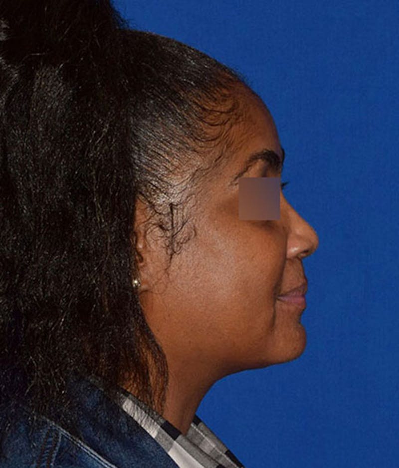 Face Before & After Gallery - Patient 63360440 - Image 6