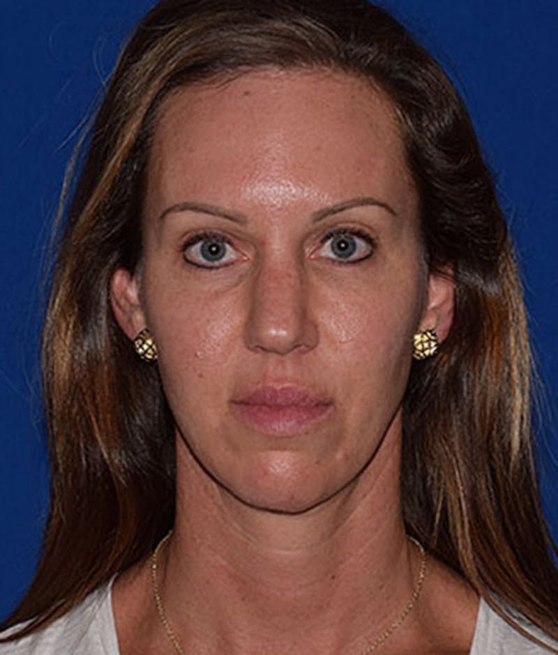 Face Before & After Gallery - Patient 63360448 - Image 1