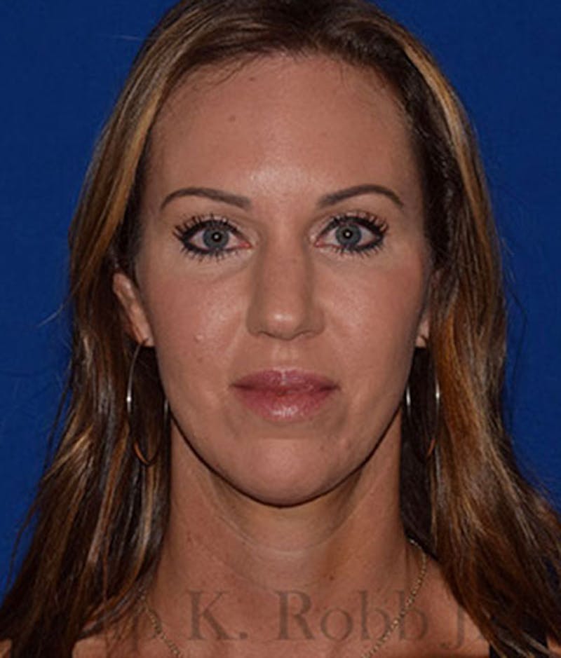 Cosmetic Surgical Before & After Gallery - Patient 63360448 - Image 2