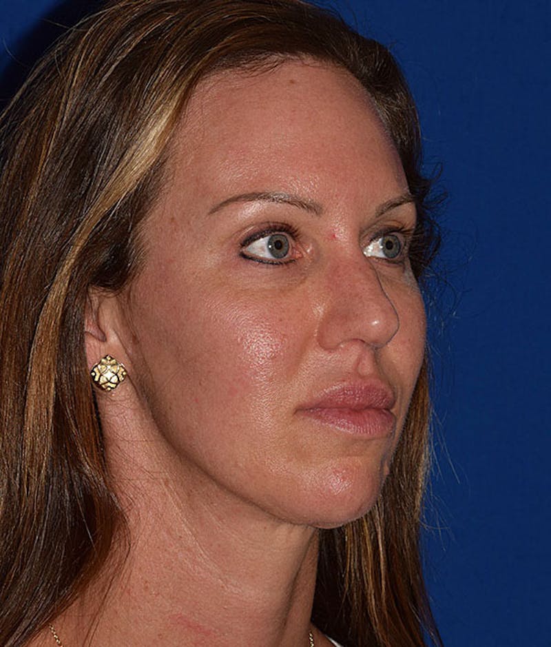 Face Before & After Gallery - Patient 63360448 - Image 3