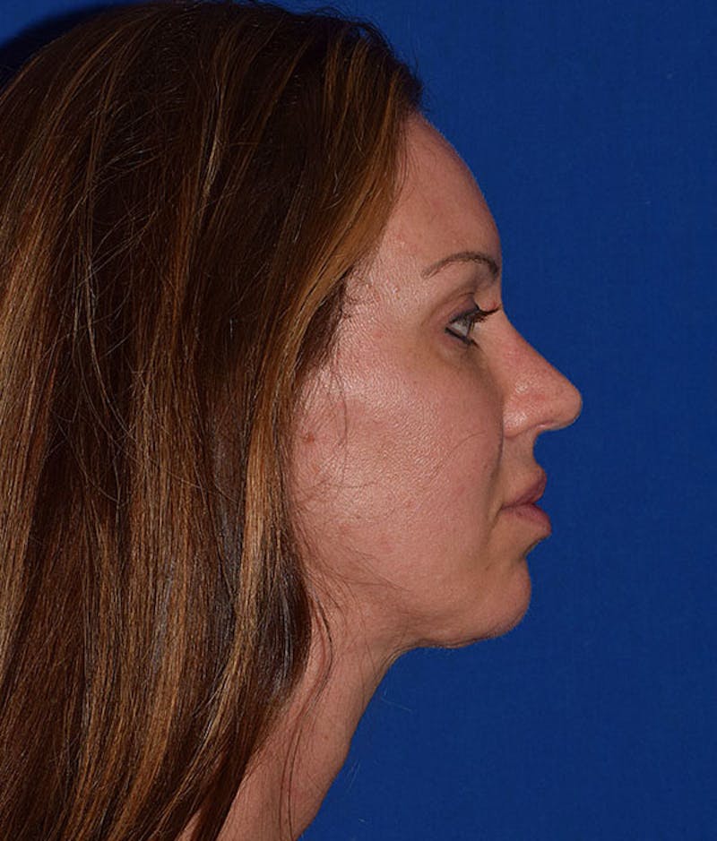 Face Before & After Gallery - Patient 63360448 - Image 5