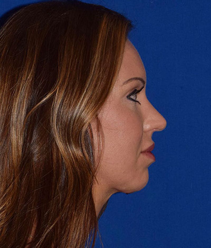Face Before & After Gallery - Patient 63360448 - Image 6