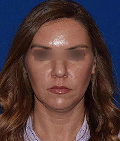 Face Before & After Gallery - Patient 63360457 - Image 1