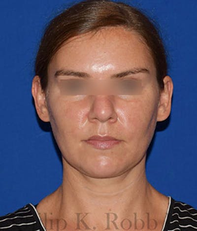 Face Before & After Gallery - Patient 63360457 - Image 2