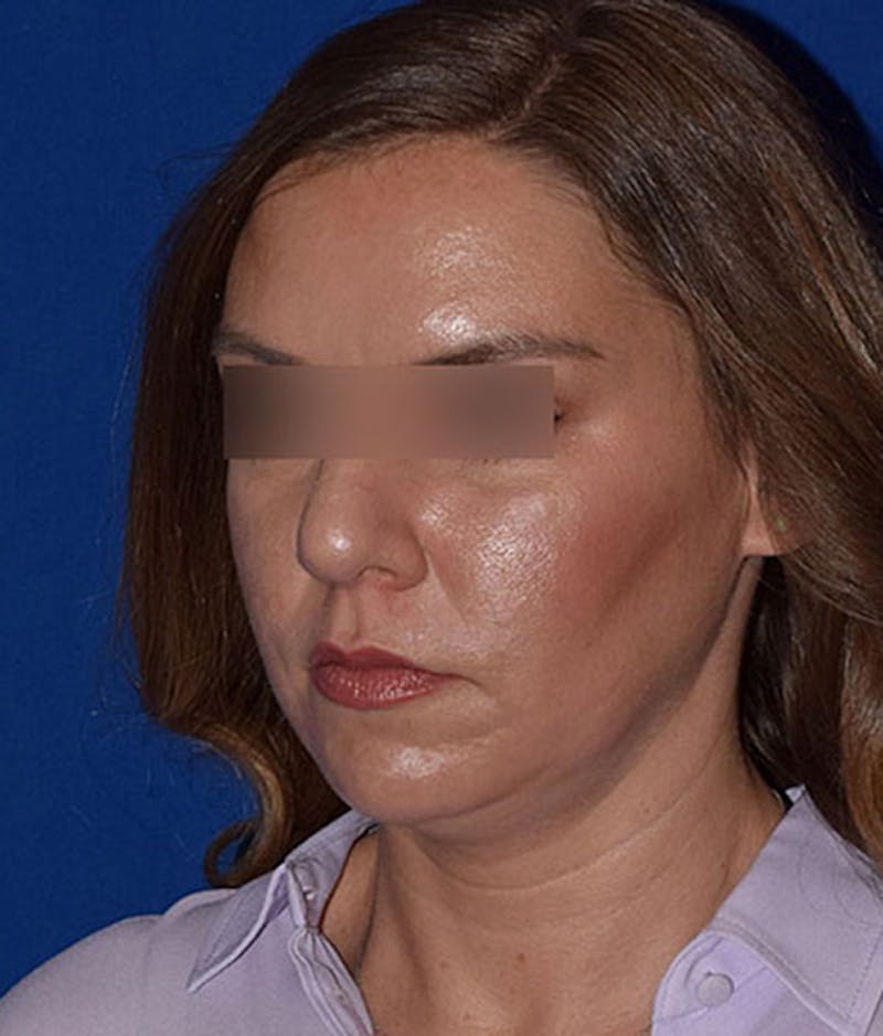 Face Before & After Gallery - Patient 63360457 - Image 3