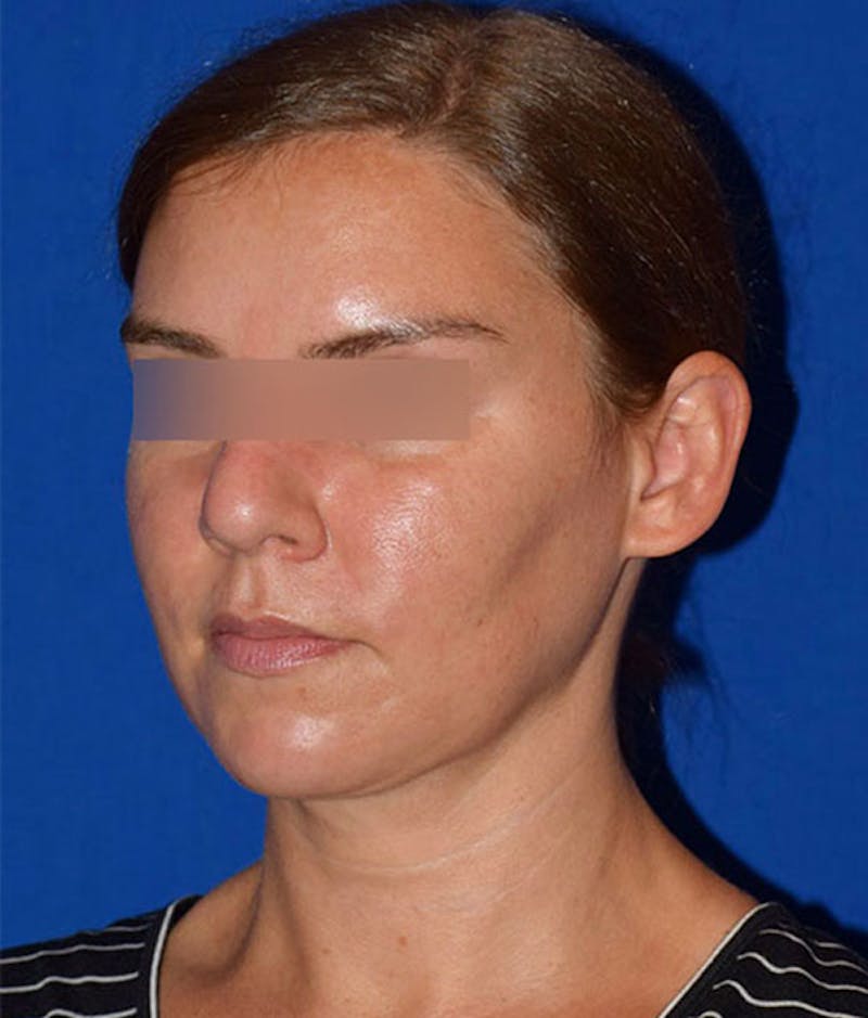 Face Before & After Gallery - Patient 63360457 - Image 4