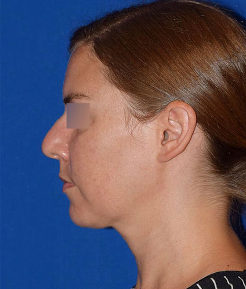 Face Before & After Gallery - Patient 63360457 - Image 6
