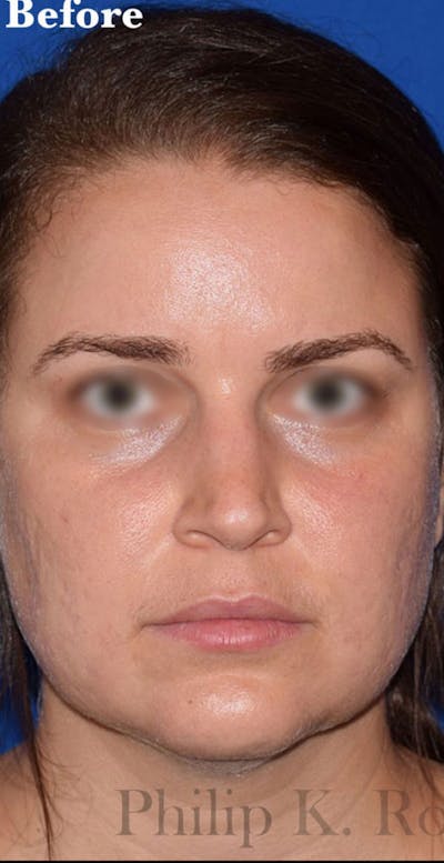 Face Before & After Gallery - Patient 63360468 - Image 1