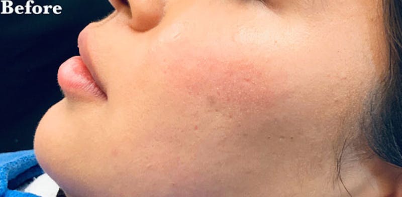 Face Before & After Gallery - Patient 63360469 - Image 1
