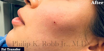 Cosmetic Surgical Before & After Gallery - Patient 63360469 - Image 2