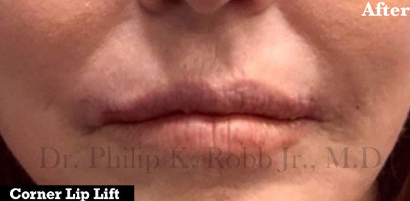 Cosmetic Surgical Before & After Gallery - Patient 63360475 - Image 2