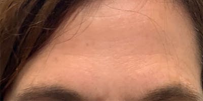 Non-Surgical Before & After Gallery - Patient 63360497 - Image 2