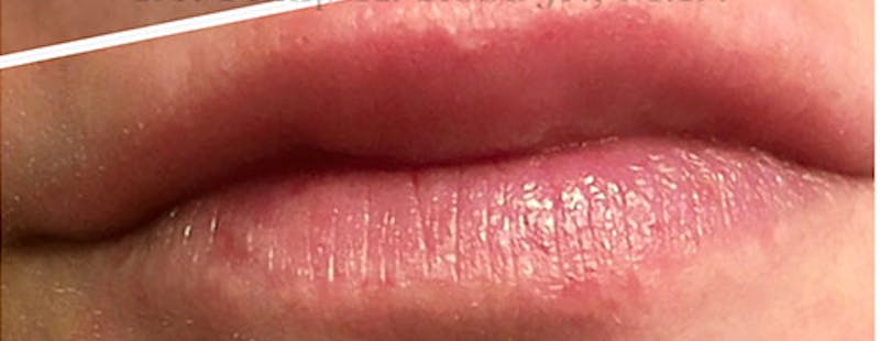 Non-Surgical Before & After Gallery - Patient 63360504 - Image 2