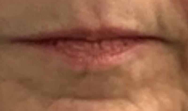 Non-Surgical Before & After Gallery - Patient 63360506 - Image 1