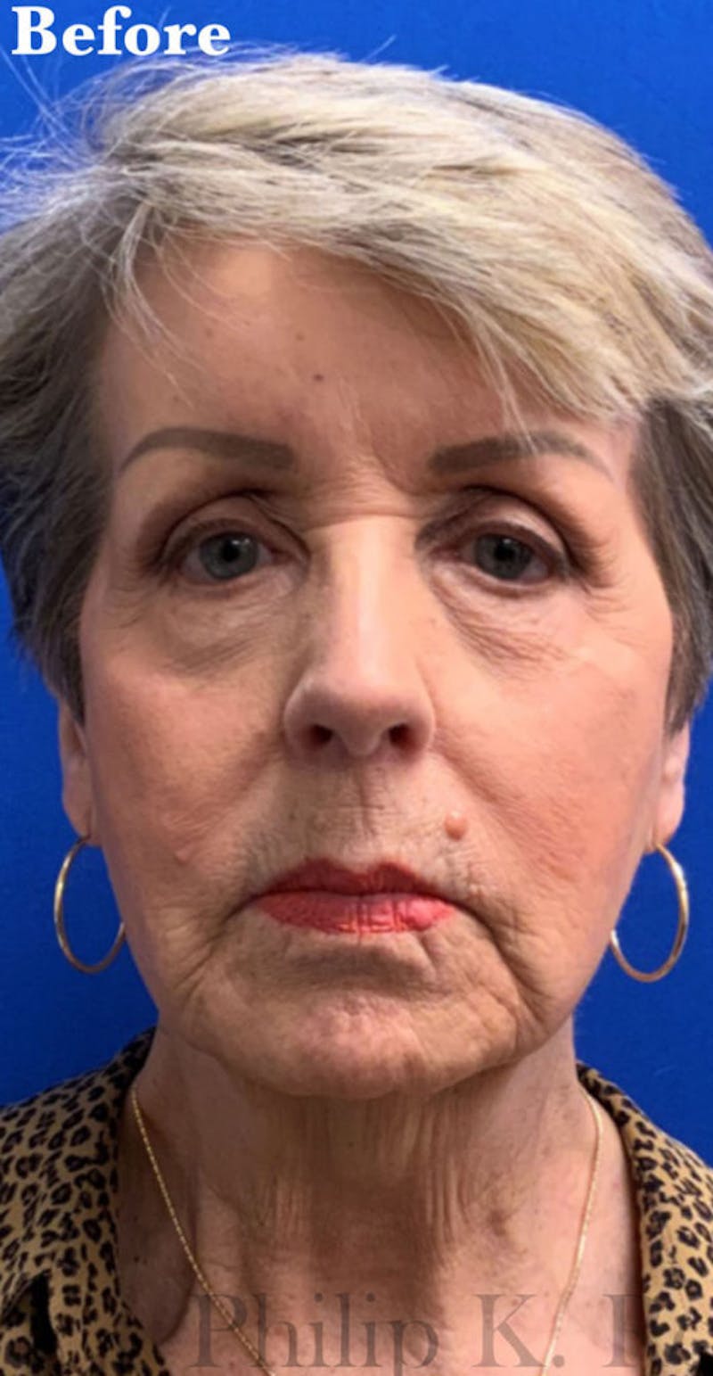 Face Before & After Gallery - Patient 122922 - Image 1