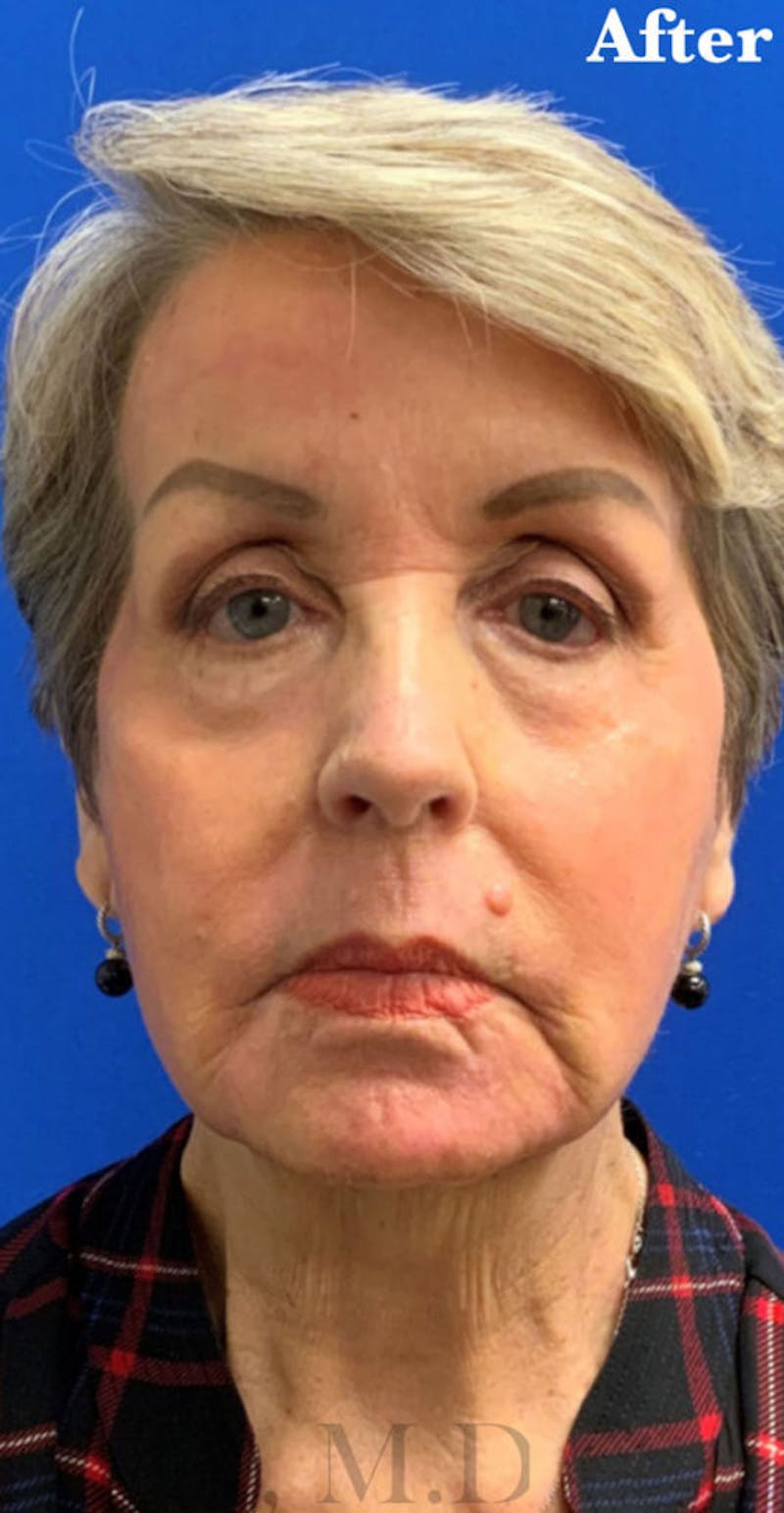 Face Before & After Gallery - Patient 122922 - Image 2