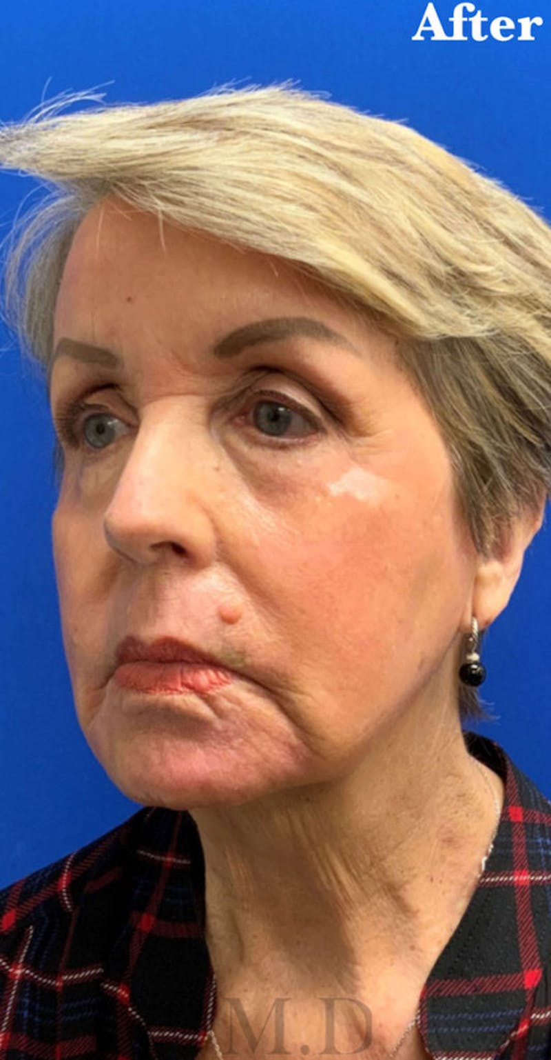 Face Before & After Gallery - Patient 122922 - Image 4