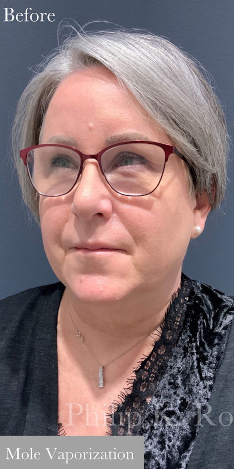 Face Before & After Gallery - Patient 63360510 - Image 3