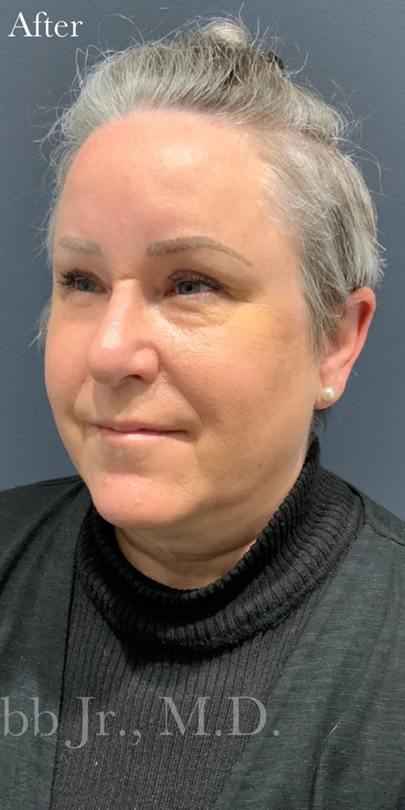 Face Before & After Gallery - Patient 63360510 - Image 4