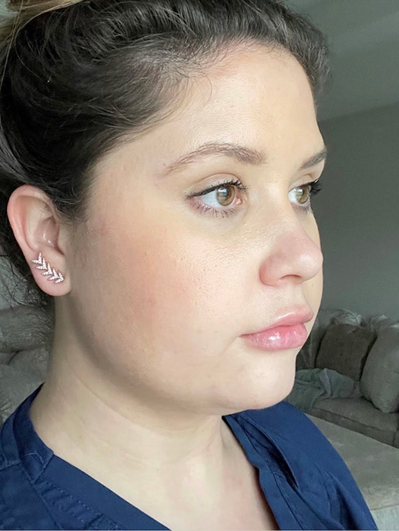 Face Before & After Gallery - Patient 63360512 - Image 3