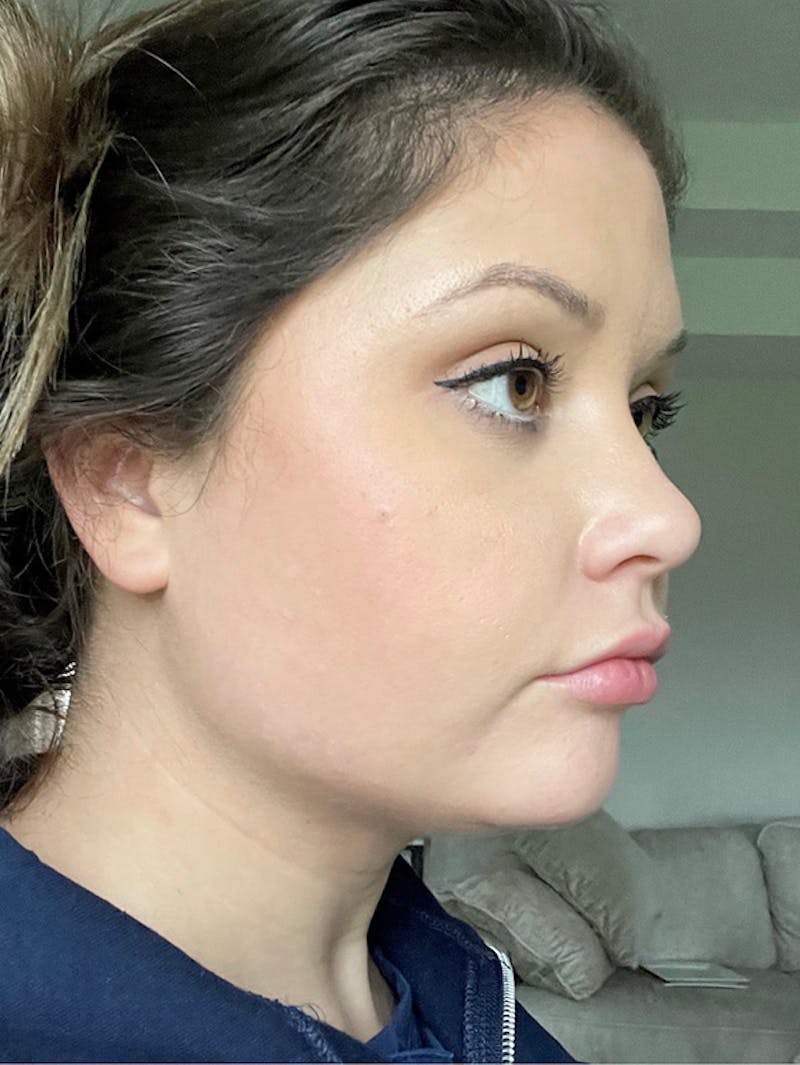 Face Before & After Gallery - Patient 63360512 - Image 4