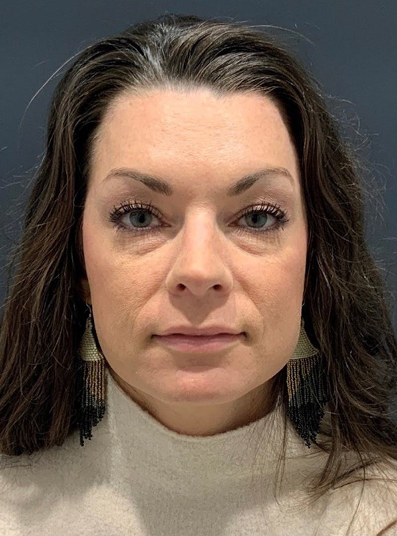 Face Before & After Gallery - Patient 63360514 - Image 1