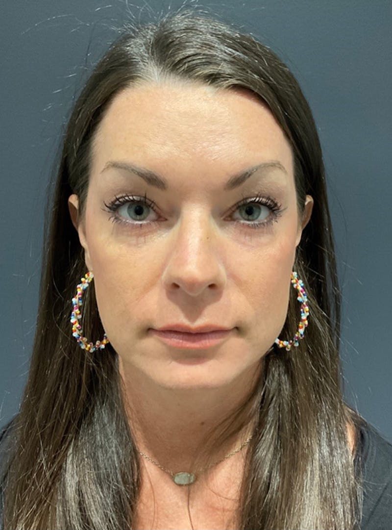 Face Before & After Gallery - Patient 63360514 - Image 2