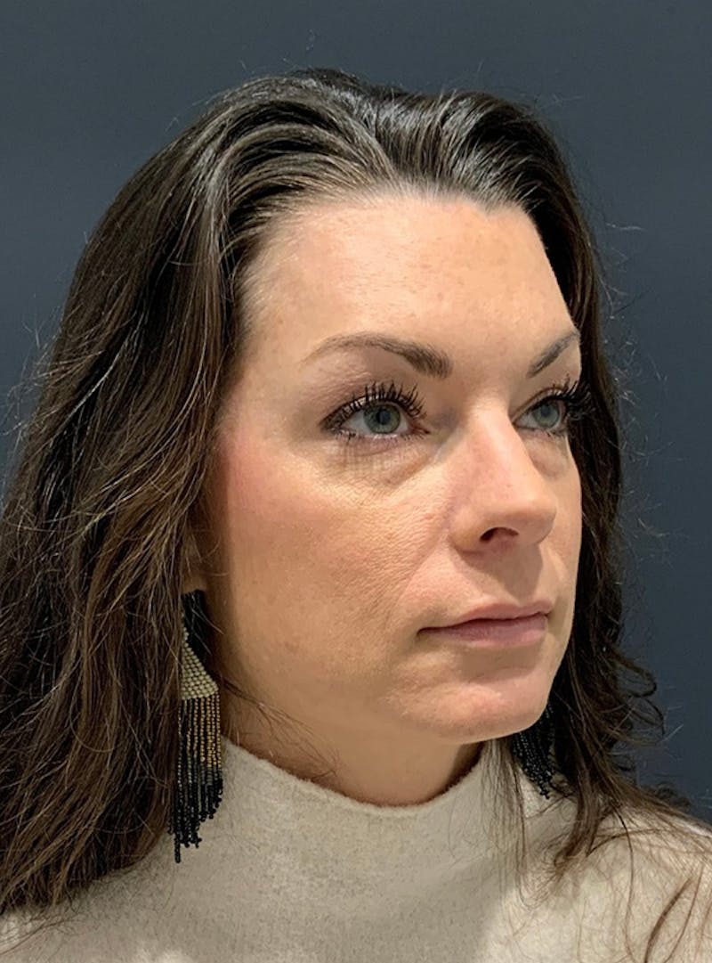 Face Before & After Gallery - Patient 63360514 - Image 3