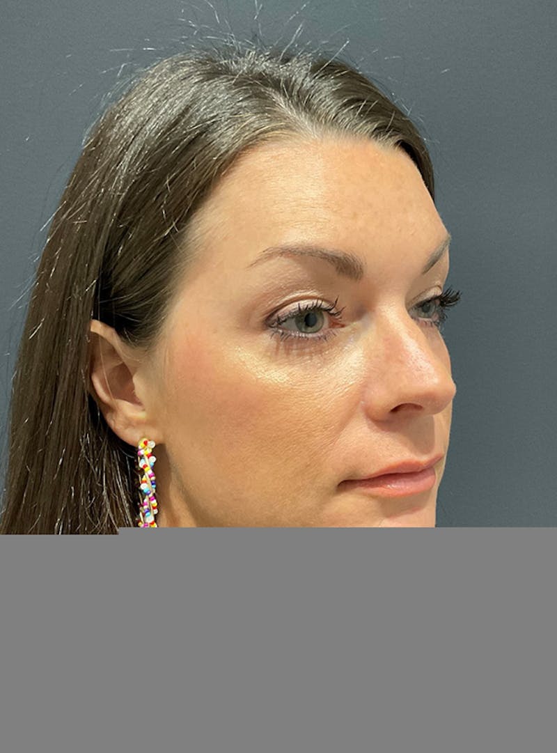 Face Before & After Gallery - Patient 63360514 - Image 4